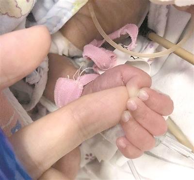 28周龄宝宝脑积水 医生实施“零出血”手术